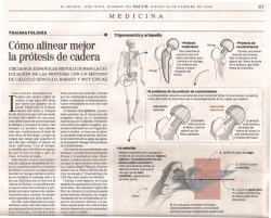C&oacute;mo alinear mejor la pr&oacute;tesis de cadera - Cl&iacute;nica Ruber