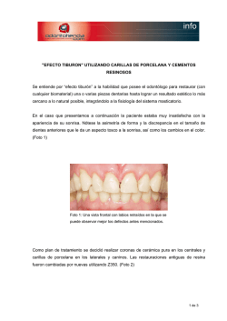 "Efecto tiburon" utilizando carillas de porcelana