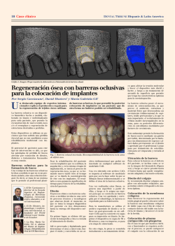 Regeneraci&oacute;n &oacute;sea con barreras oclusivas para la colocaci&oacute;n de
