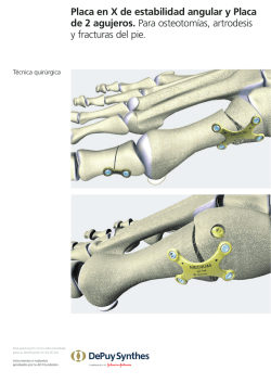 Placa en X de estabilidad angular y Placa de 2 agujeros.