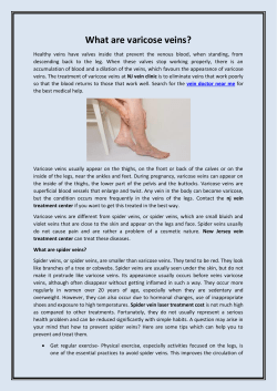 What are varicose veins