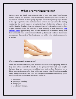 What are varicose veins