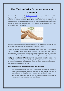 How Varicose Veins Occur and what is its treatment