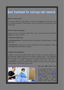 Best treatment for varicose vein removal
